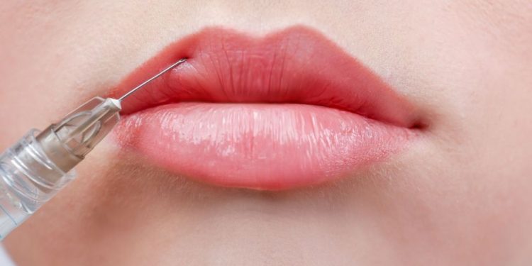 Filler bibir